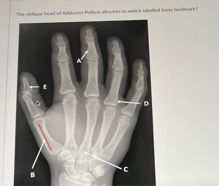 The Oblique Head Of Adductor Pollicis Attaches To Which Labelled Bony Landmark B E 4 C D 1