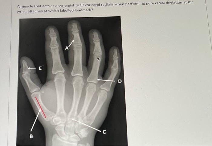 A Muscle That Acts As A Synergist To Flexor Carpi Radialis When Performing Pure Radial Deviation At The Wrist Attaches 1