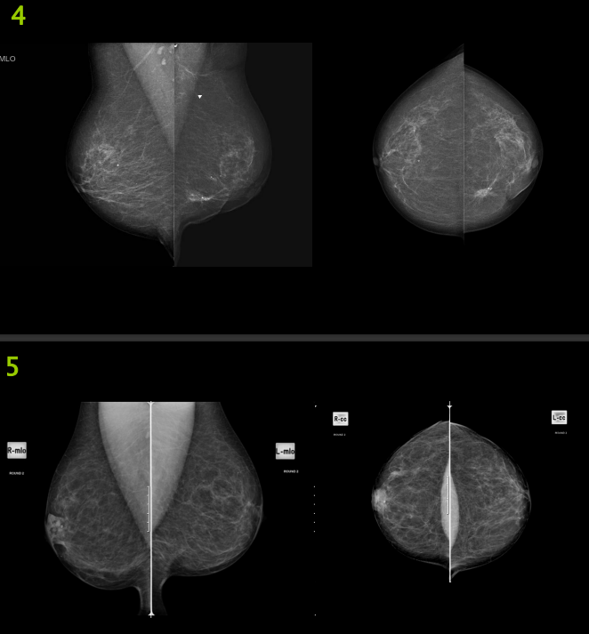The Image Below Are Mammography Images Please Evaluate Them Using Pgmi Guideline And Answer Them As In The Table Below 1