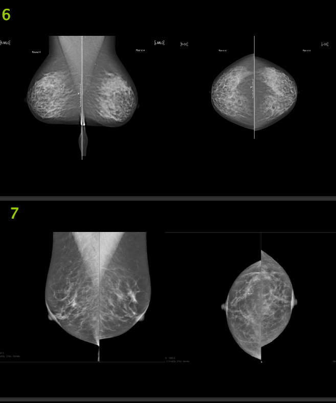 The Image Below Are Mammography Images Please Evaluate Them Using Pgmi Guideline And Answer Them As In The Table Below 2