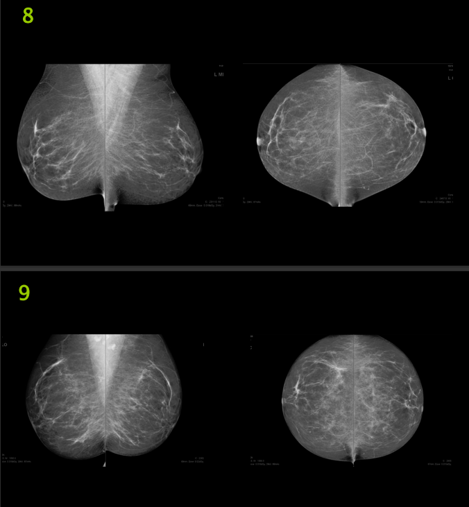 The Image Below Are Mammography Images Please Evaluate Them Using Pgmi Guideline And Answer Them As In The Table Below 3