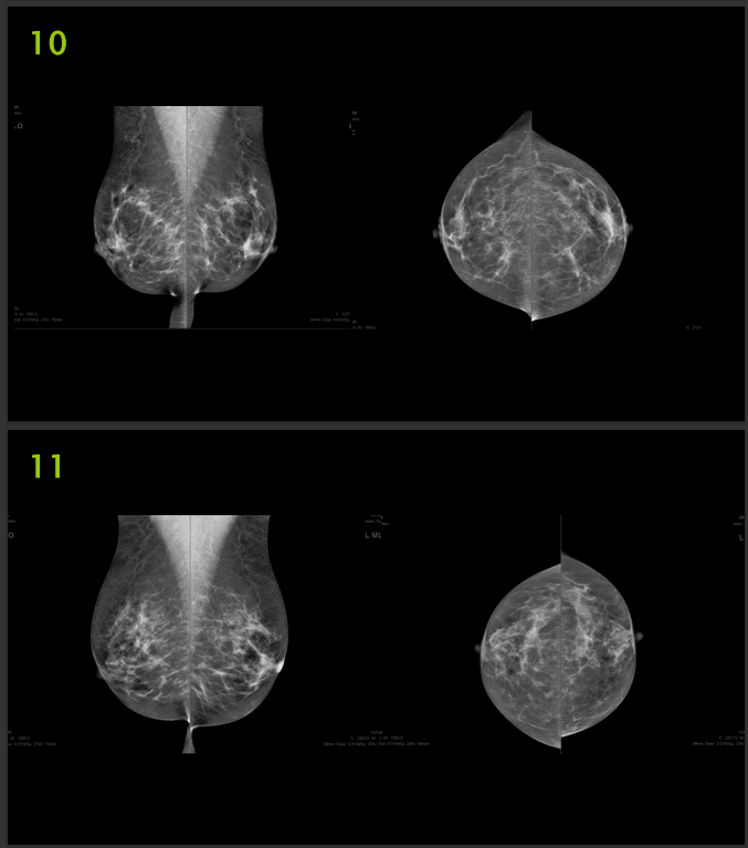 The Image Below Are Mammography Images Please Evaluate Them Using Pgmi Guideline And Answer Them As In The Table Below 1