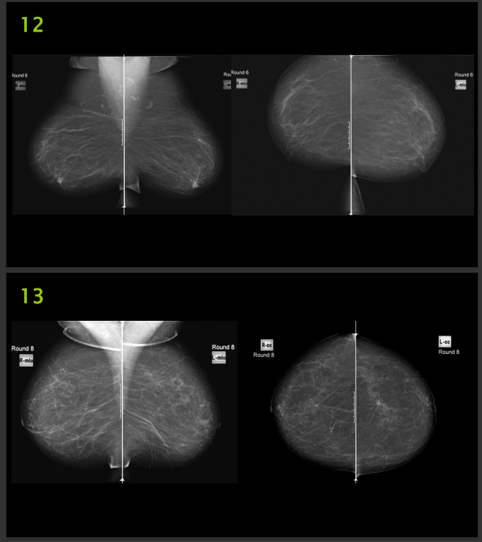 The Image Below Are Mammography Images Please Evaluate Them Using Pgmi Guideline And Answer Them As In The Table Below 2
