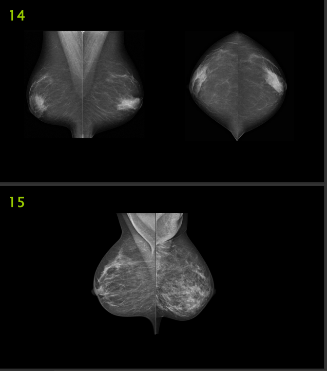 The Image Below Are Mammography Images Please Evaluate Them Using Pgmi Guideline And Answer Them As In The Table Below 3