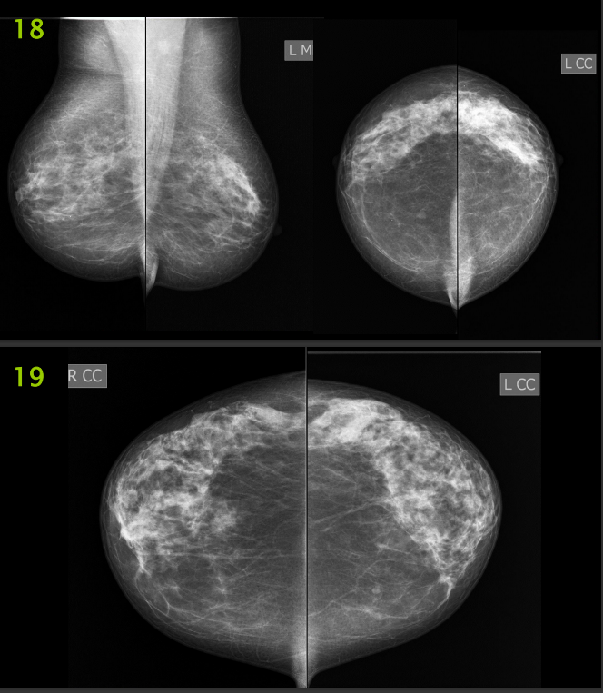 The Image Below Are Mammography Images Please Evaluate Them Using Pgmi Guideline And Answer Them As In The Table Below 3