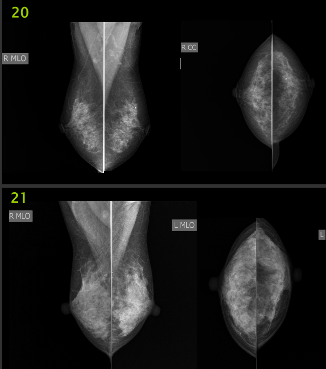 The Image Below Are Mammography Images Please Evaluate Them Using Pgmi Guideline And Answer Them As In The Table Below 4