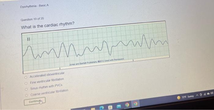 Dysthythmia Basic A Question 10 Of 35 What Is The Cardiac Rhythm Ii Nam Unmur Bp00012 Accelerated Idioventricular Fin 2