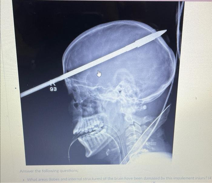 93 Answer The Following Questions What Areas Lobes And Internal Structures Of The Brain Have Been Damaged By This Imp 1