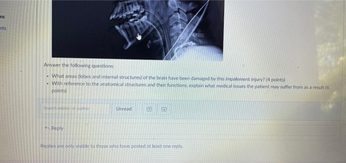 93 Answer The Following Questions What Areas Lobes And Internal Structures Of The Brain Have Been Damaged By This Imp 3