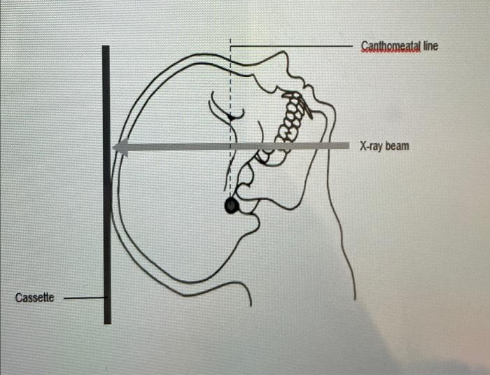 Cassette F Canthomeatal Line X Ray Beam Cassette 45 Canthomeatal Line Dashed Line X Ray Beam 1
