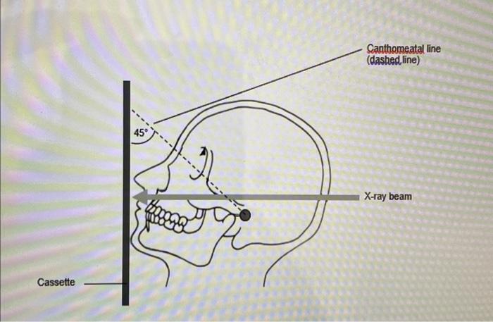Cassette F Canthomeatal Line X Ray Beam Cassette 45 Canthomeatal Line Dashed Line X Ray Beam 2