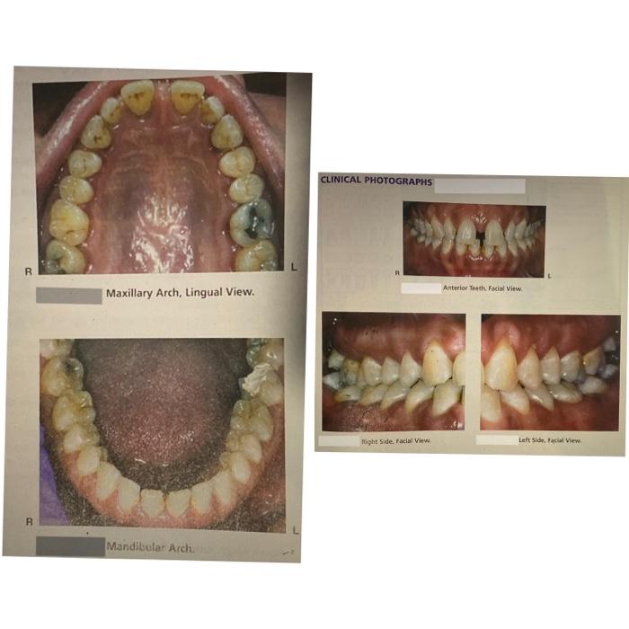 Right D Radiographs E Left R Maxillary Arch Lingual View Mandibular Arch Clinical Photographs Right Side Facial Vie 3