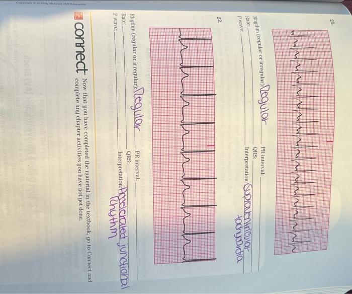 Rhythm Regular Or Irregular Egular Rate P Wave 19 18 Rhythm Regular Or Irregular Rate P Wave 20 194 Rhythm R 2