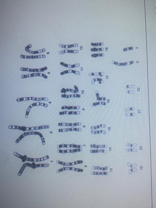 Turner Syndrome Is An Inherited Condition In Which One Of The Two X Chromosomes Normally Present In Each Cell Is Missing 2