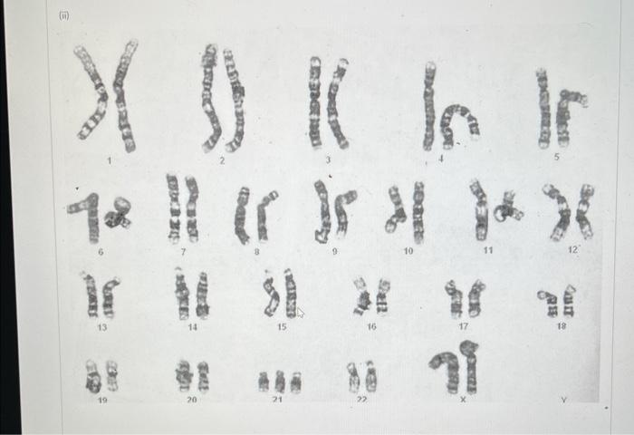Provide The Proper Chromosomal Designation And Genetic Condition For I And Ii If Applicable For The Two Karyotypes 3