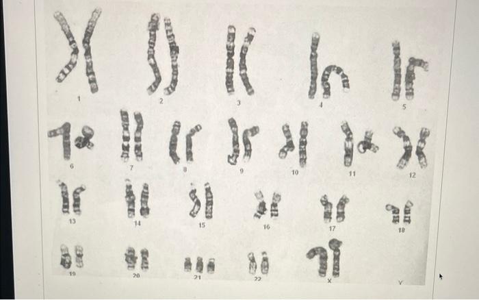 Provide The Proper Chromosomal Designation And Genetic Condition For I And Ii If Applicable For The Two Karyotypes 2