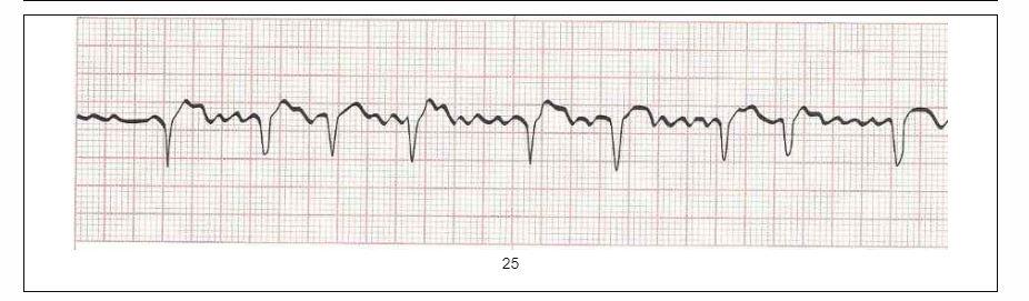 Classify The Heart Rhythm From The Ecg Strip 1