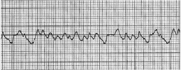 Cpr Is In Progr 1