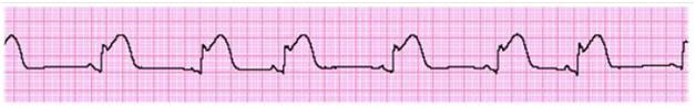 A Patient With  1