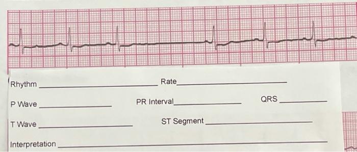 Rhythm Rate Qrs P Wave Pr Interval T Wave St Segment Interpretation 1