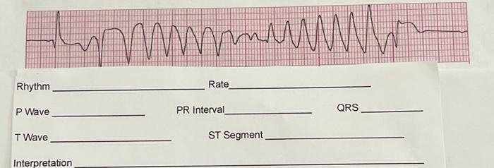 Mm Rhythm Rate P Wave Pr Interval Qrs T Wave St Segment Interpretation 1