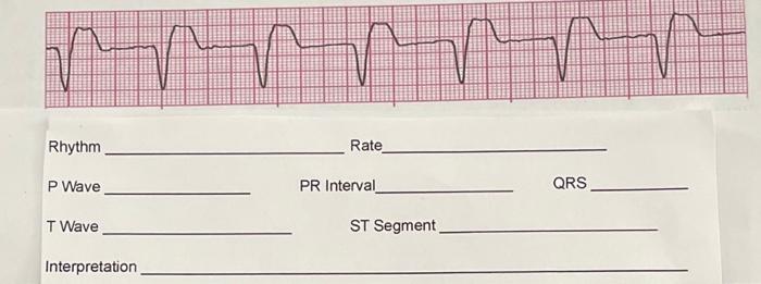 Rhythm Rate P Wave Pr Interval Qrs T Wave St Segment Interpretation 1